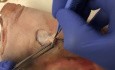 Skin Cancer Surgery - Bi-lobe Flap
