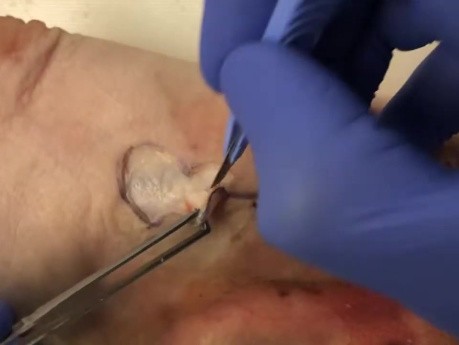 Skin Cancer Surgery - Bi-lobe Flap