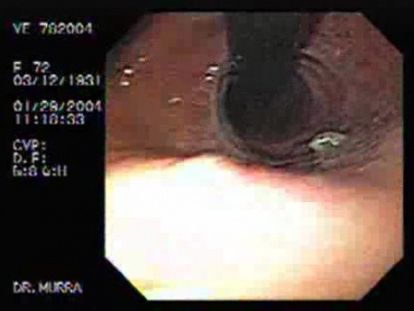 Mallory-Weiss Syndrome - 54 Years-Old Female