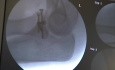 ORIF Intra-Articular Radial Head Fracture Surgery