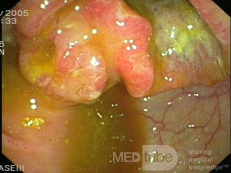 Cancer Of The Cecum