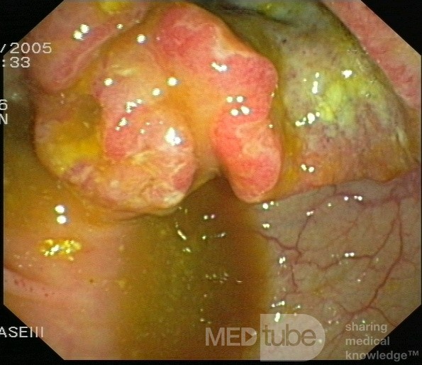 Cancer Of The Cecum
