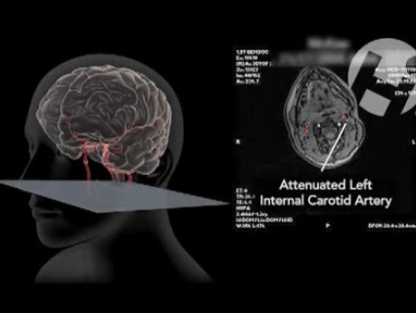 Carotid Dissection and Propagated Clot