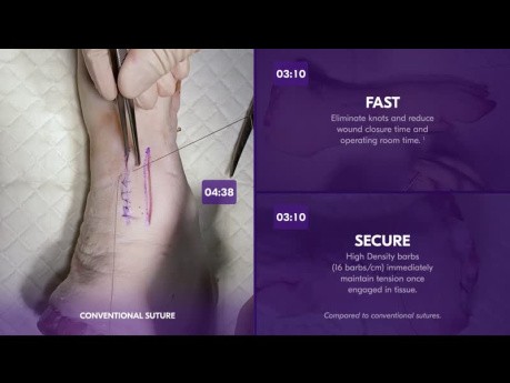 Quill® Barbed Suture vs. Conventional Suture