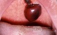 Palatal Hematoma
