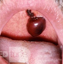 Palatal Hematoma
