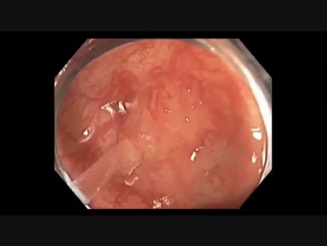 Colonoscopy Channel - How To Identify A Subtle Flat Lesion
