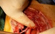 Critical RTA Injuries