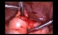 IUD Migration Into Sigmoid  - Managed Laparoscopically
