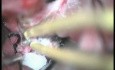 Sphenoidal Wing Meningioma - Left Pterional Approach