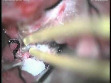 Sphenoidal Wing Meningioma - Left Pterional Approach