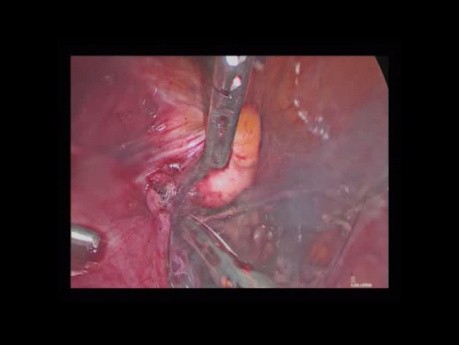 Laparoscopic Hysterectomy of Myomatous Uterus
