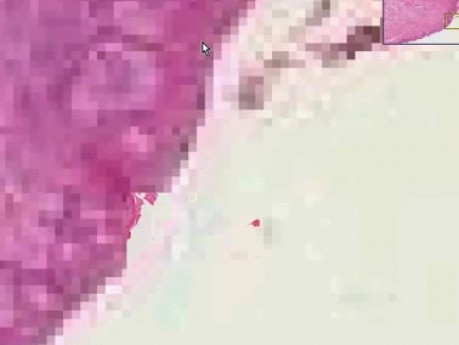 Paget disease - Histopathology - Breast