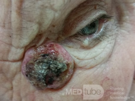 Basal Cell Carcinoma (1)