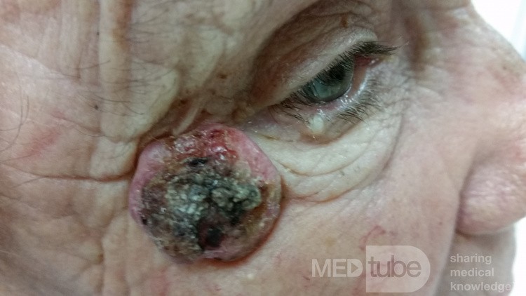 Basal Cell Carcinoma (1)