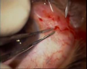 Silicone Oil Removal + Phacoemulsification