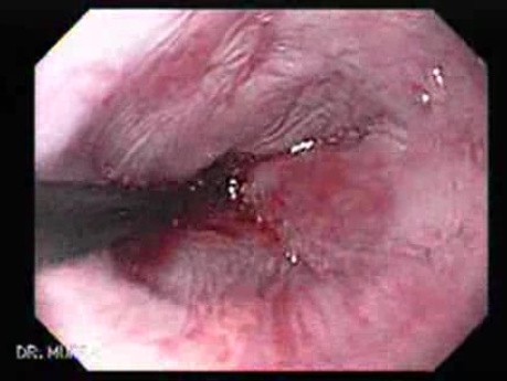 Dilation of the Stricture Caused by Adenocarcinoma, Part 2