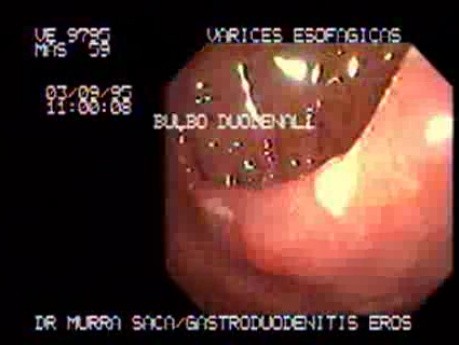 Erosive Gastroduodenitis