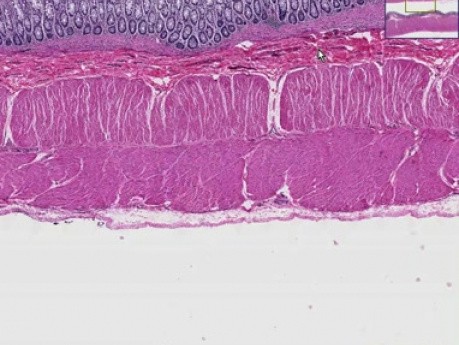 Hirschsprung disease