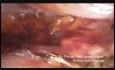 Total Hysterectomy Using Harmonic Ace with Advanced Hemostasis