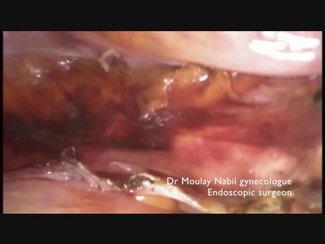 Total Hysterectomy Using Harmonic Ace with Advanced Hemostasis