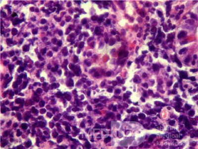 Gastroduodenal MALToma (10 of 12)