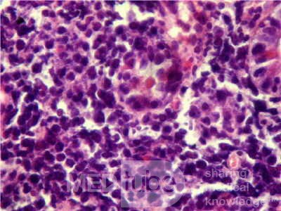 Gastroduodenal MALToma (10 of 12)
