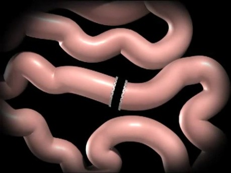 Duodenal Switch Animation
