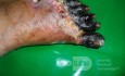 Diabetic Foot Gangrene (Forefoot) 