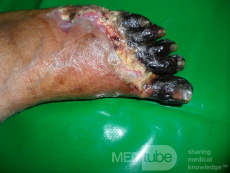 Diabetic Foot Gangrene (Forefoot) 