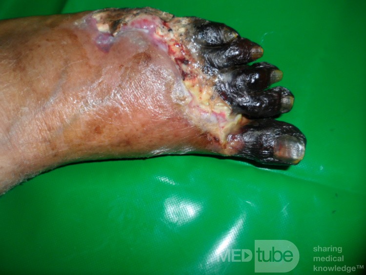 Diabetic Foot Gangrene (Forefoot) 