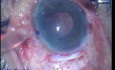 Endothelial keratoplasty- 27G bent needle