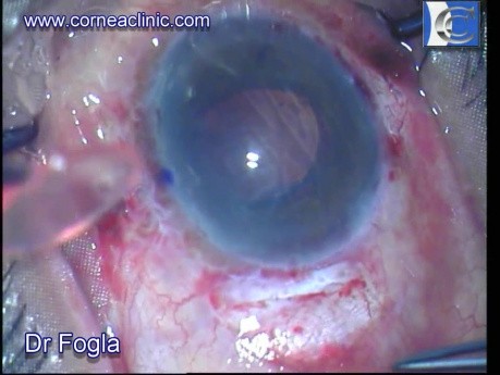 Endothelial keratoplasty- 27G bent needle