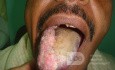Tongue tumor