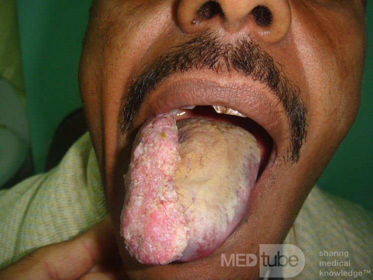 Tongue tumor