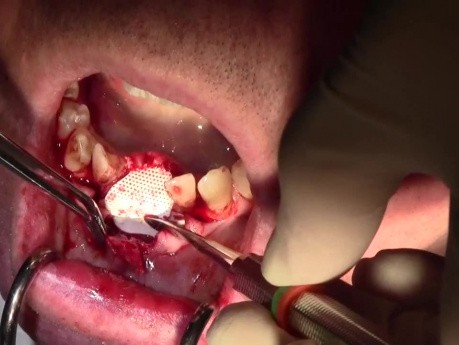 Resorbable Membrane, Mineross, and Emdogain - Extraction #24/25 with Ridge Augmentation - d-PTFE