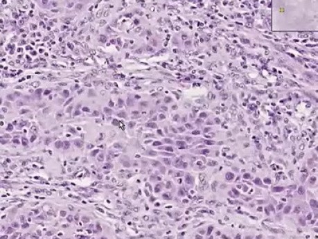 Squamous cell carcinoma - Histopathology of skin