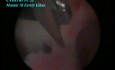 Central Intra Uterine Adhesions After Cesarean Section - Laparoscopic Treatment