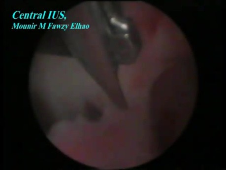 Central Intra Uterine Adhesions After Cesarean Section - Laparoscopic Treatment