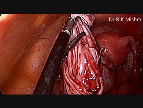 Laparoscopic Surgery for Ovarian Cyst