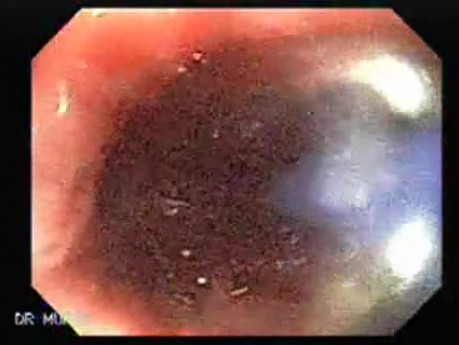 Esophageal Achalasia - Impaction of foreign bodies (piece of meat) (4 of 5)