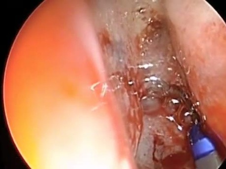 Implantation of Frontal Sinus