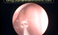 Probing and Mobilization of Nasal Polyps 