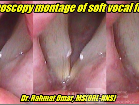 Soft Vocal Fold Nodules