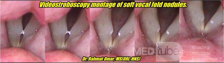 Soft Vocal Fold Nodules