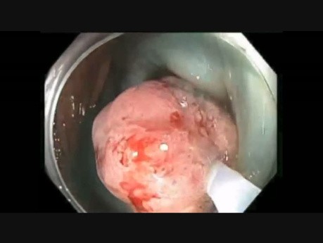Colonoscopy Channel Quiz 13