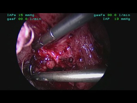 Laparoscopic Removal of Eroded Mesh With Esophageal Reconstruction for Esophageal Salvage