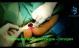 Laser Anal Fissure