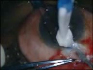 Glaucoma Surgery