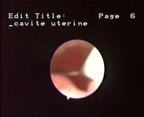 Hysteroscopic Aspect Of Intrauterine Device (IUD)